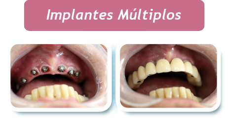 Implantes Multiplos