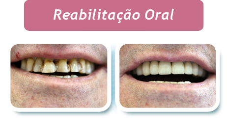 Rebilitação Oral